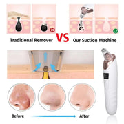 Blackhead Remover | Face Acne Black Dot Pimple Electric Blackhead Vacuum Cleaner